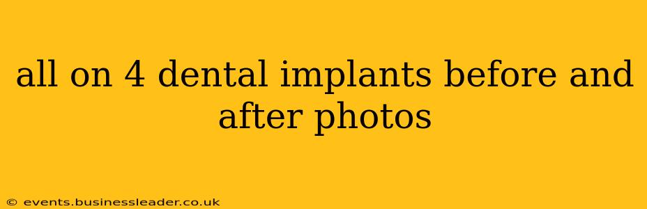 all on 4 dental implants before and after photos