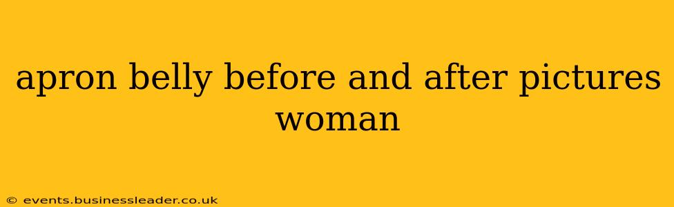 apron belly before and after pictures woman