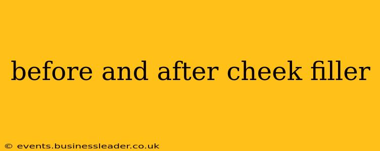 before and after cheek filler