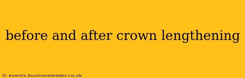 before and after crown lengthening