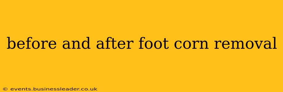 before and after foot corn removal