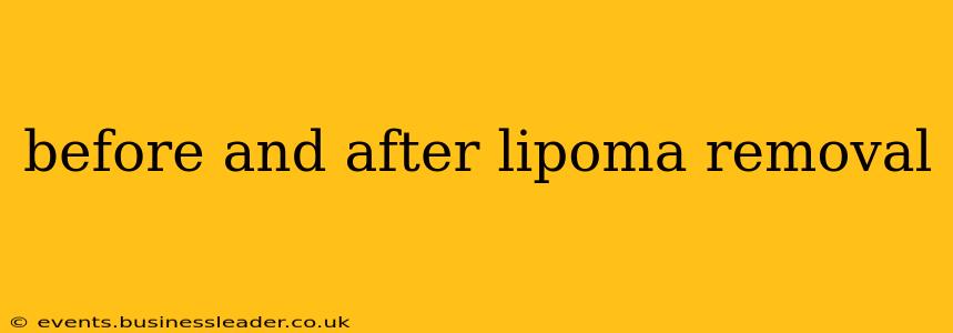 before and after lipoma removal