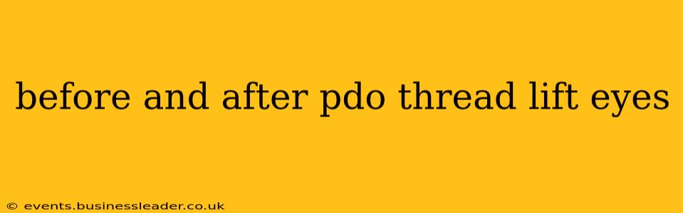 before and after pdo thread lift eyes