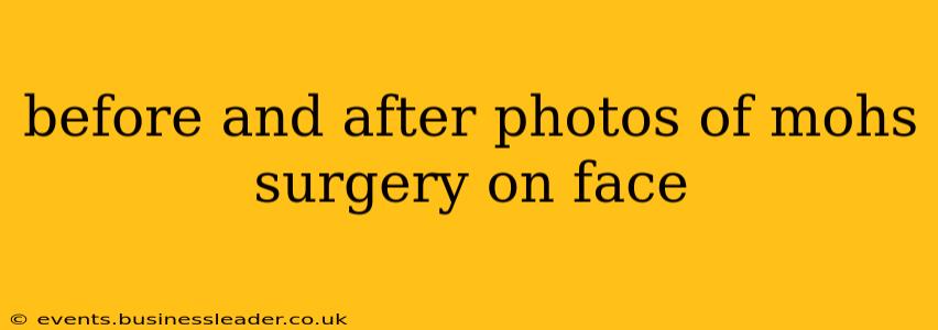 before and after photos of mohs surgery on face
