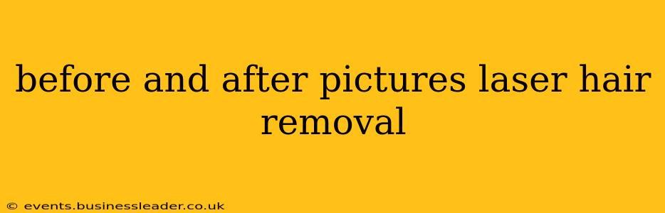 before and after pictures laser hair removal