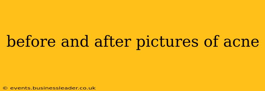 before and after pictures of acne
