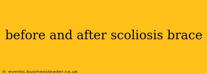 before and after scoliosis brace