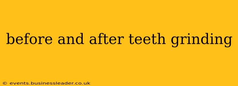 before and after teeth grinding