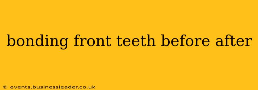 bonding front teeth before after