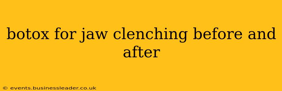 botox for jaw clenching before and after