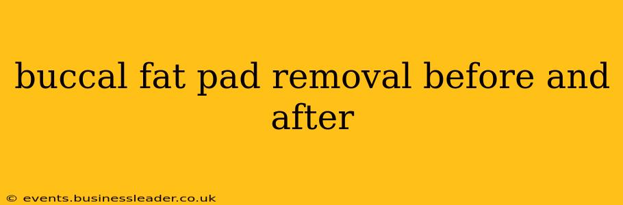 buccal fat pad removal before and after
