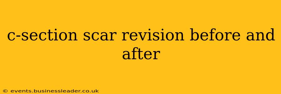 c-section scar revision before and after
