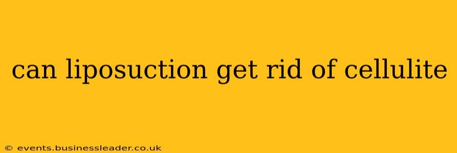 can liposuction get rid of cellulite