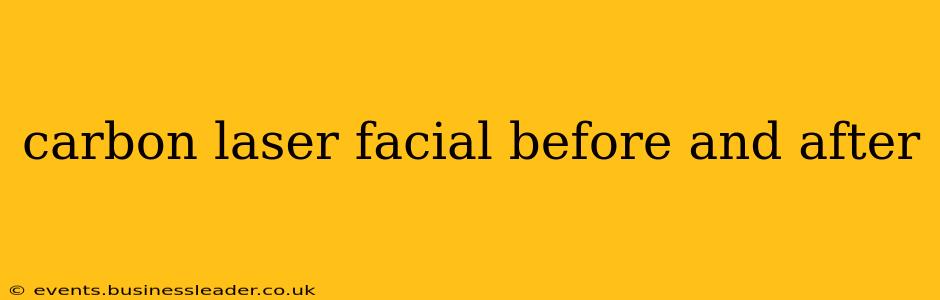 carbon laser facial before and after