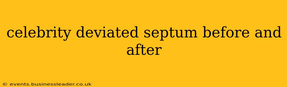 celebrity deviated septum before and after