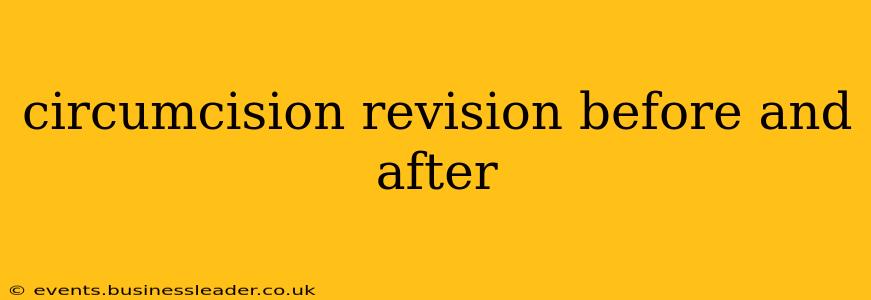 circumcision revision before and after