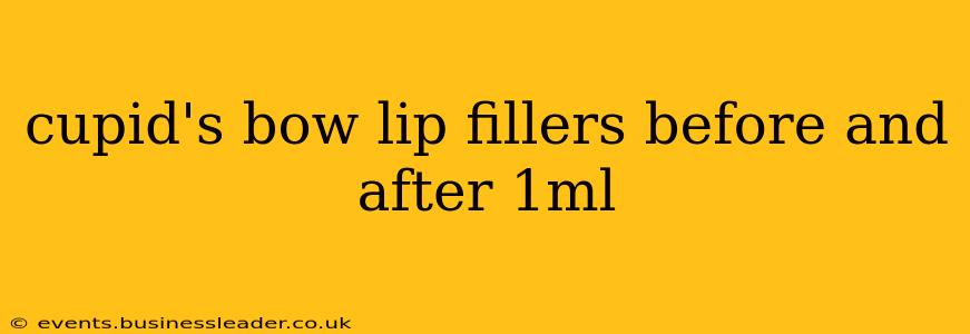 cupid's bow lip fillers before and after 1ml