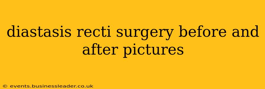 diastasis recti surgery before and after pictures
