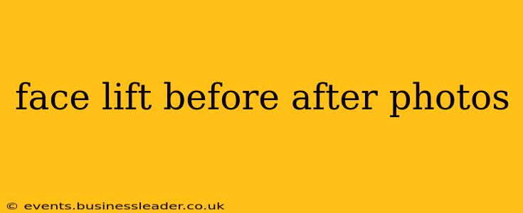 face lift before after photos