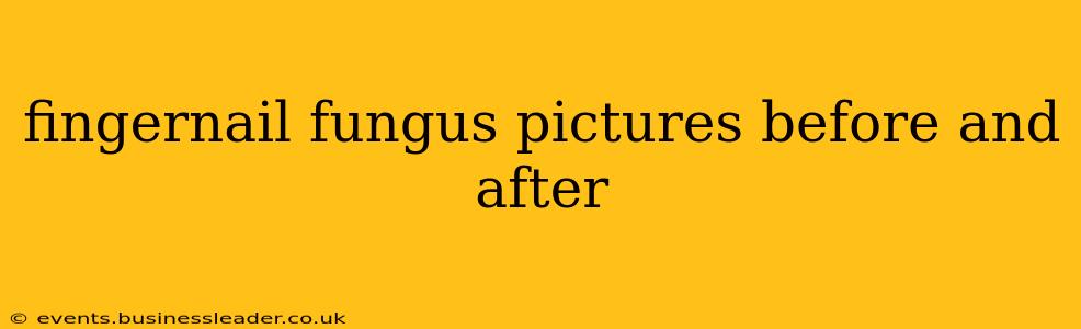 fingernail fungus pictures before and after