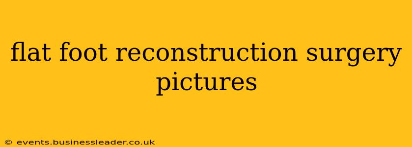 flat foot reconstruction surgery pictures