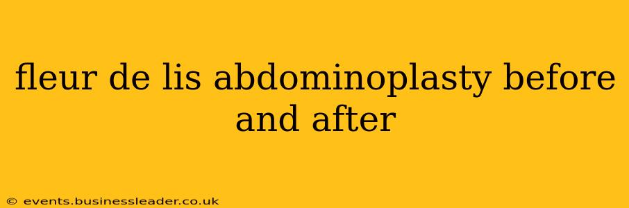fleur de lis abdominoplasty before and after