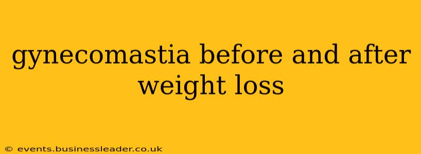 gynecomastia before and after weight loss