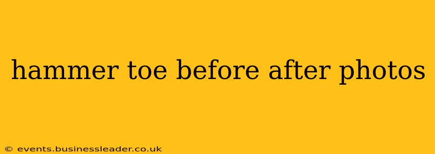 hammer toe before after photos