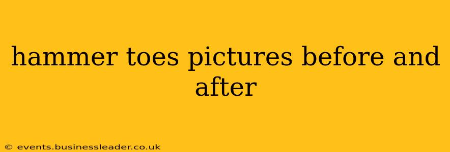 hammer toes pictures before and after