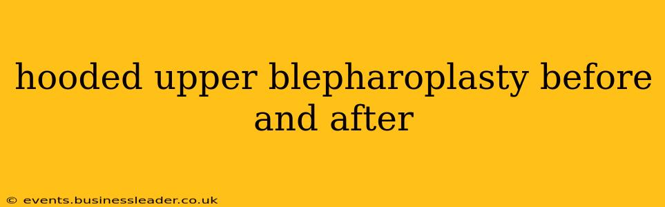 hooded upper blepharoplasty before and after