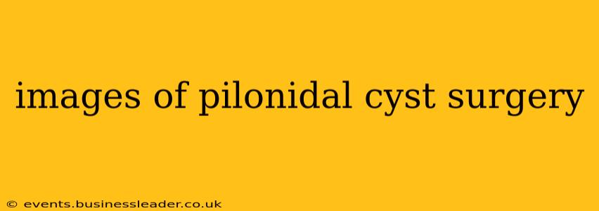 images of pilonidal cyst surgery