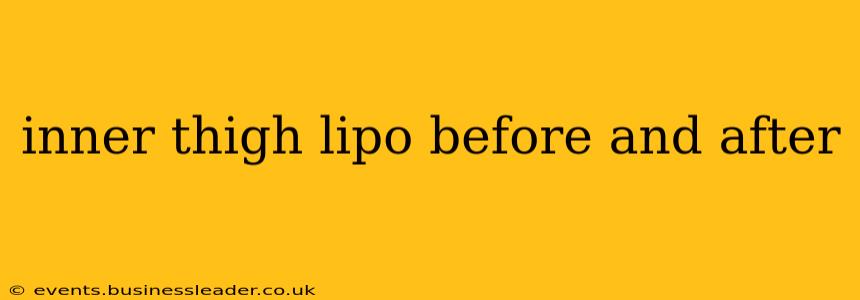 inner thigh lipo before and after