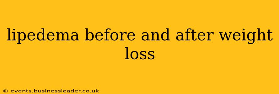 lipedema before and after weight loss