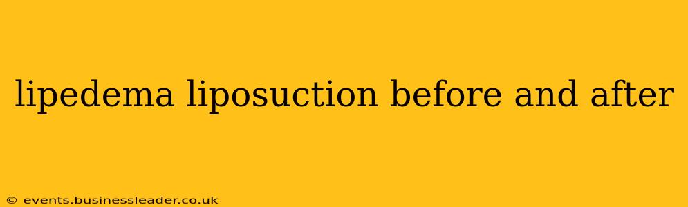 lipedema liposuction before and after