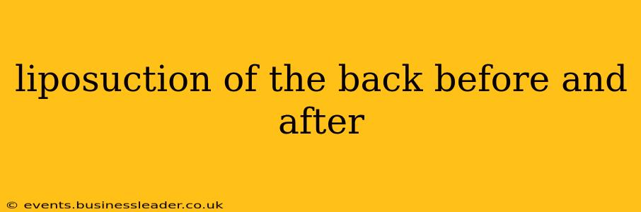 liposuction of the back before and after