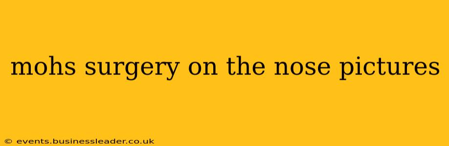mohs surgery on the nose pictures