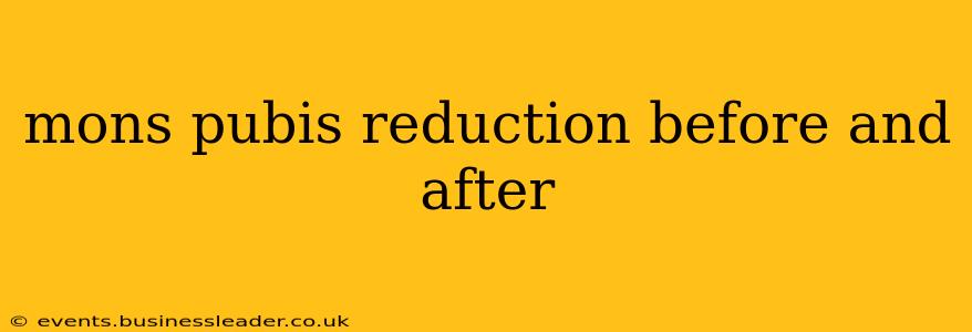 mons pubis reduction before and after