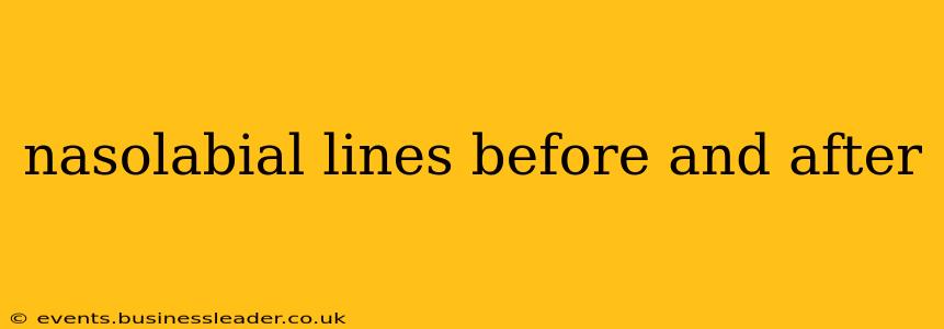 nasolabial lines before and after