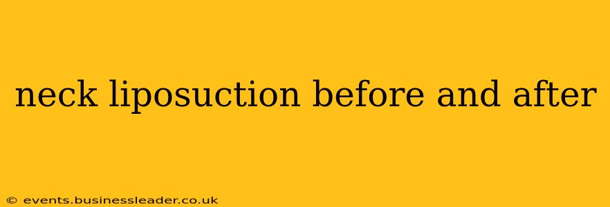 neck liposuction before and after