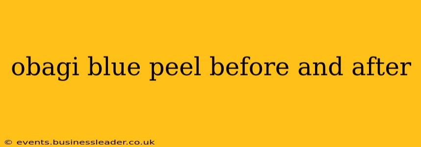 obagi blue peel before and after