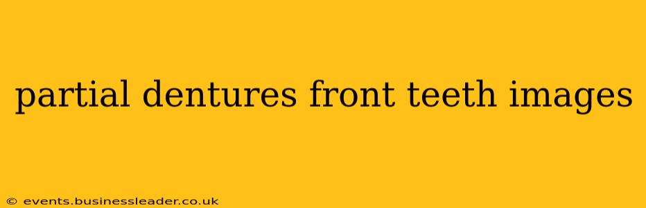 partial dentures front teeth images