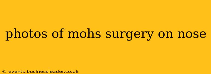 photos of mohs surgery on nose