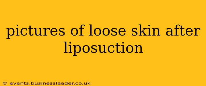 pictures of loose skin after liposuction