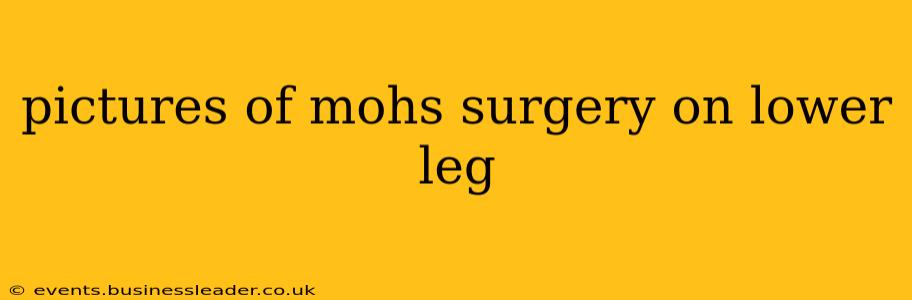 pictures of mohs surgery on lower leg