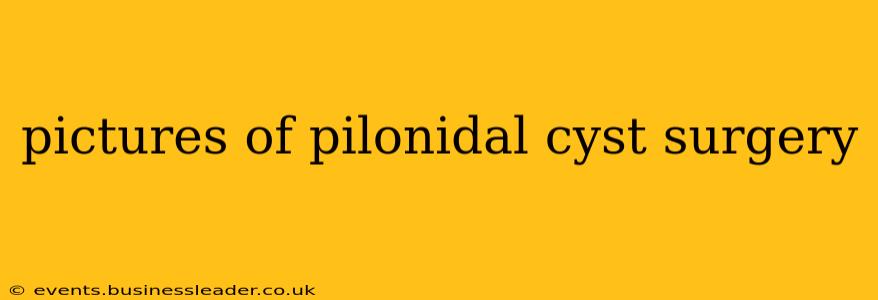 pictures of pilonidal cyst surgery