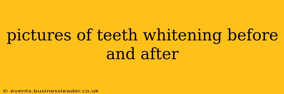 pictures of teeth whitening before and after