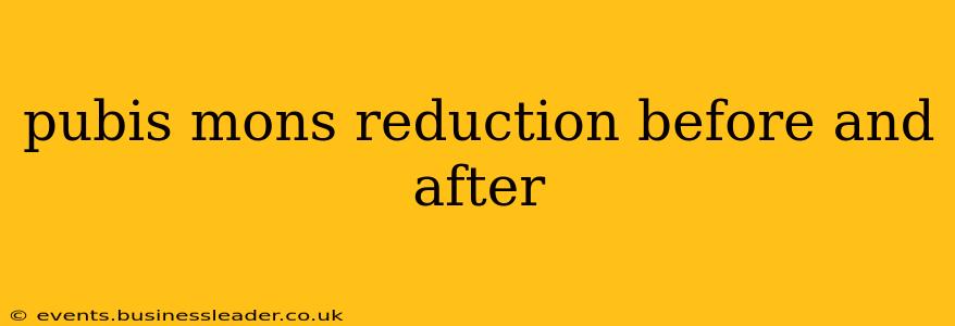 pubis mons reduction before and after