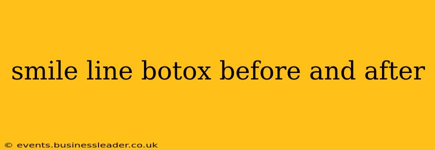 smile line botox before and after
