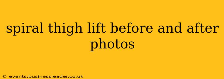 spiral thigh lift before and after photos
