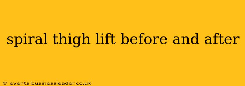 spiral thigh lift before and after